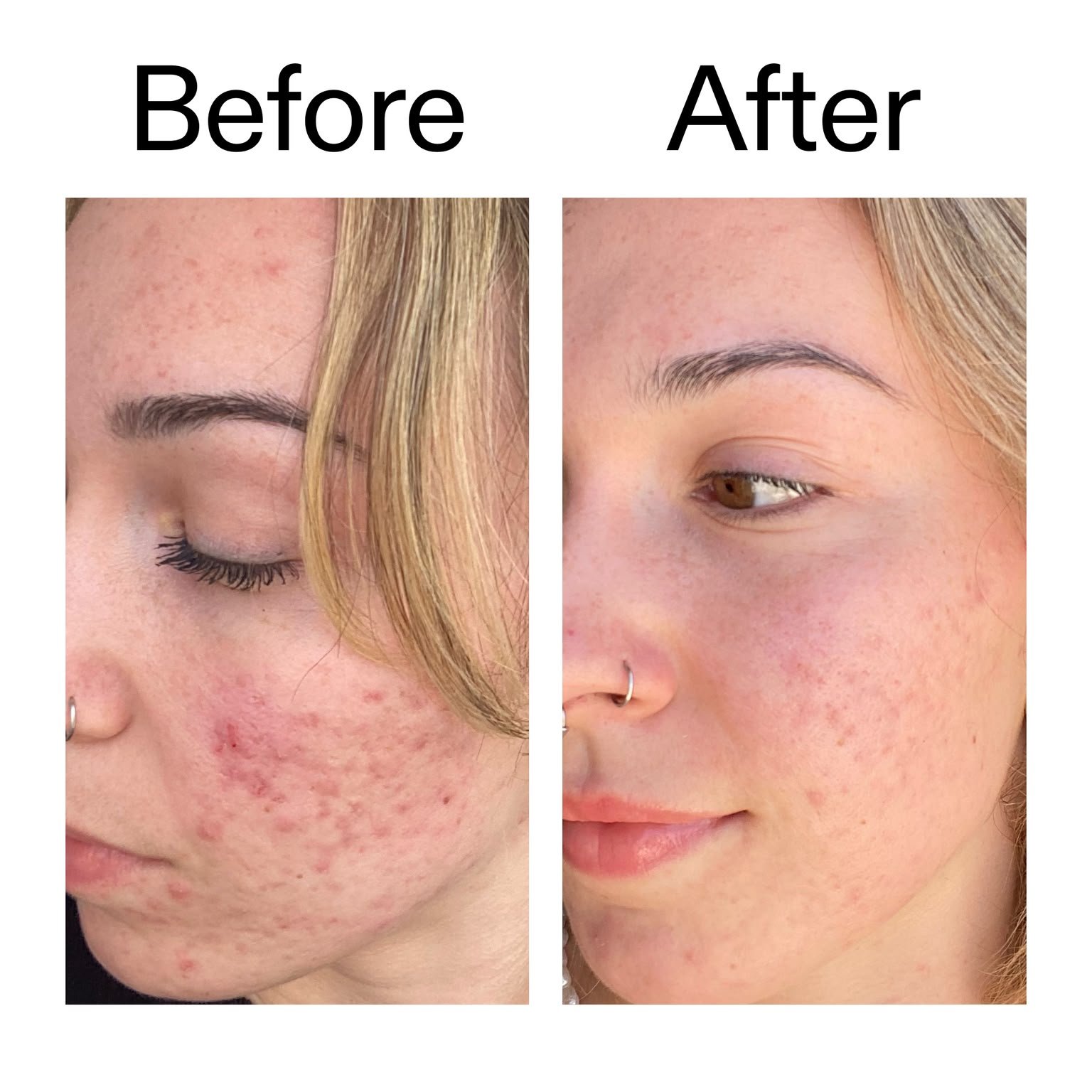 The INKEY List 10% Azelaic Acid Serum 30ml