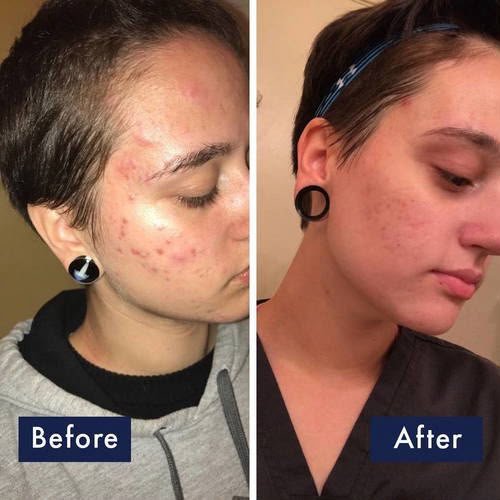 PanOxyl Acne Foaming Wash 10% Benzoyl Peroxide 85g