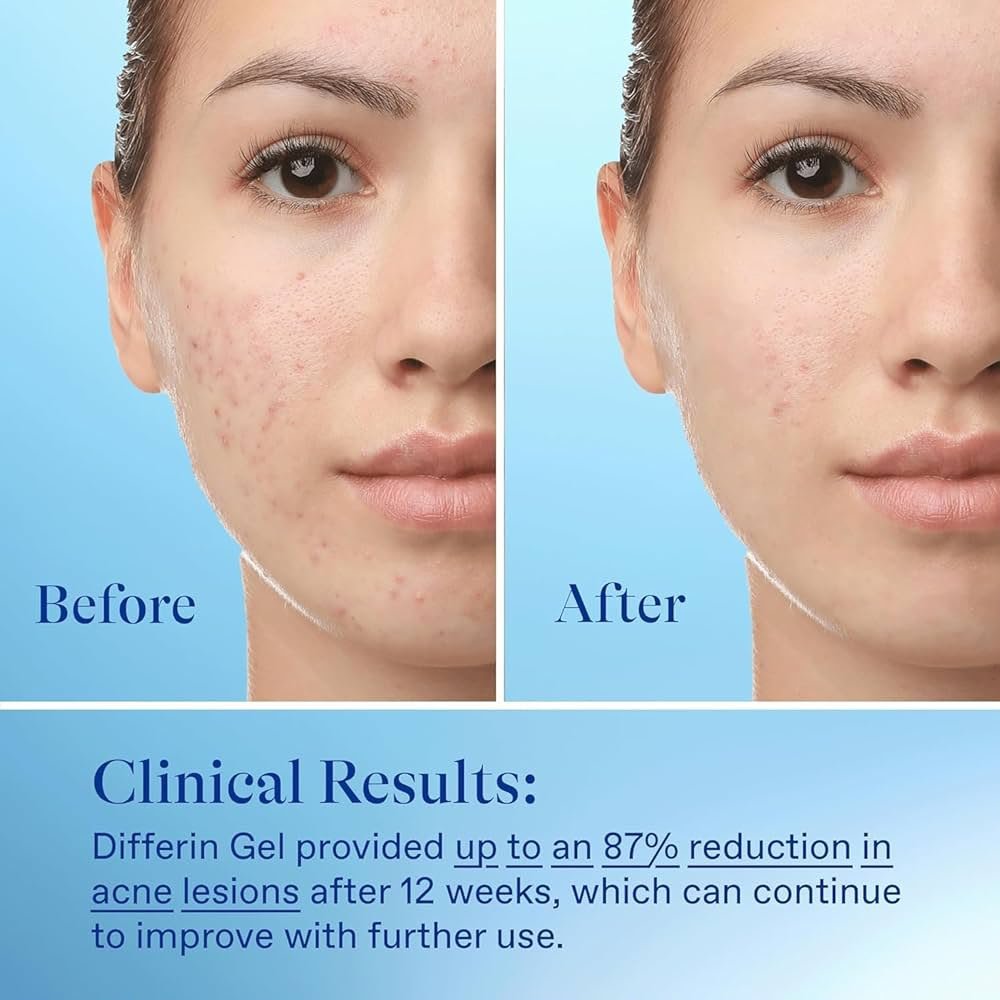 Differin Adapalene Gel 0.1 % Acne Treatment 15g